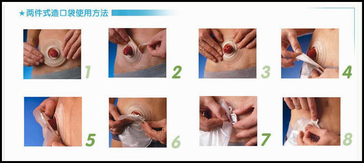 思泰利二件式尿路造口袋胶盘 两件式底盘 膀胱切除术后用 一盒5个