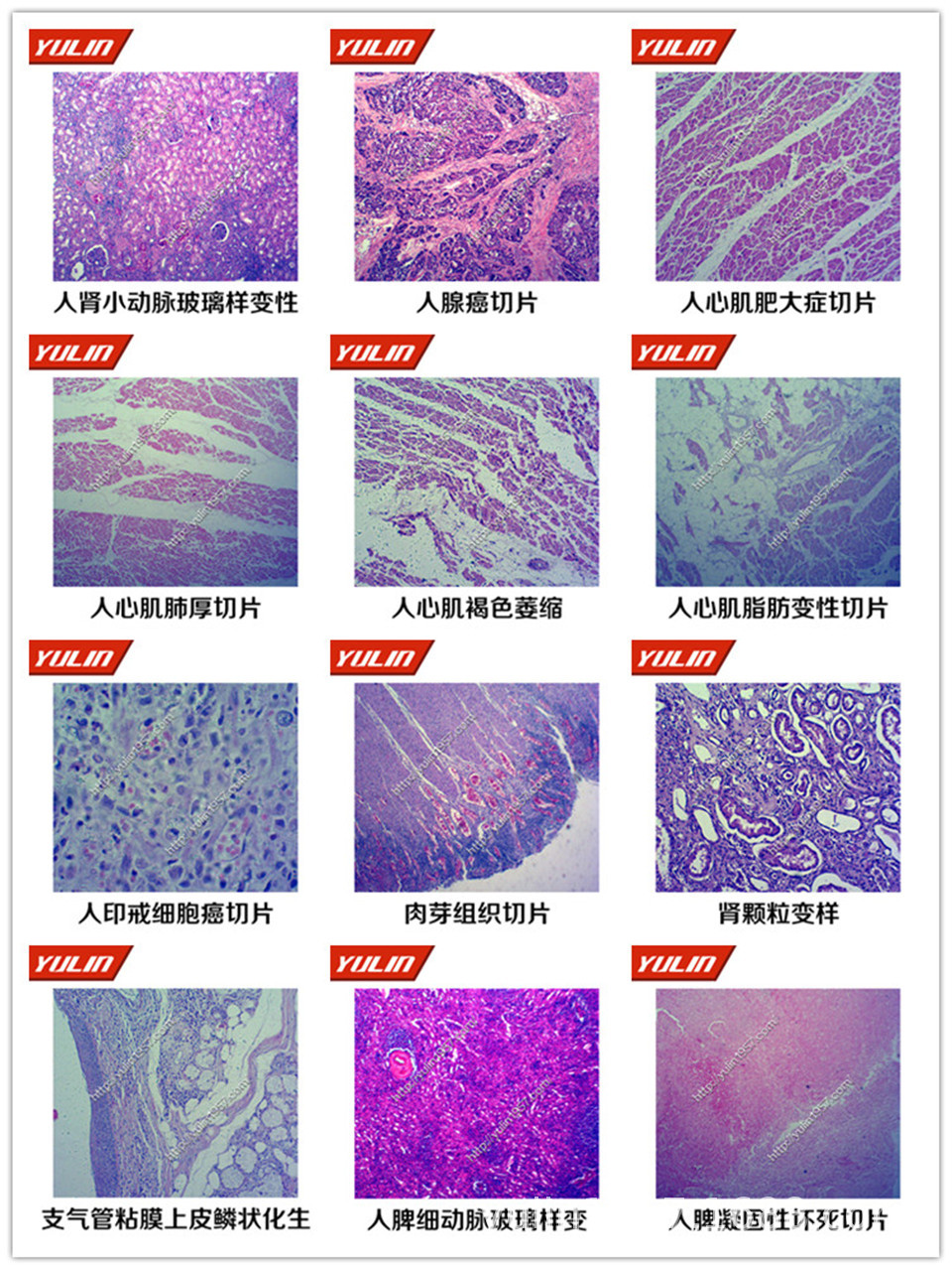 人体病理学造血系统病理切片 生物玻片 人鼻息肉切片