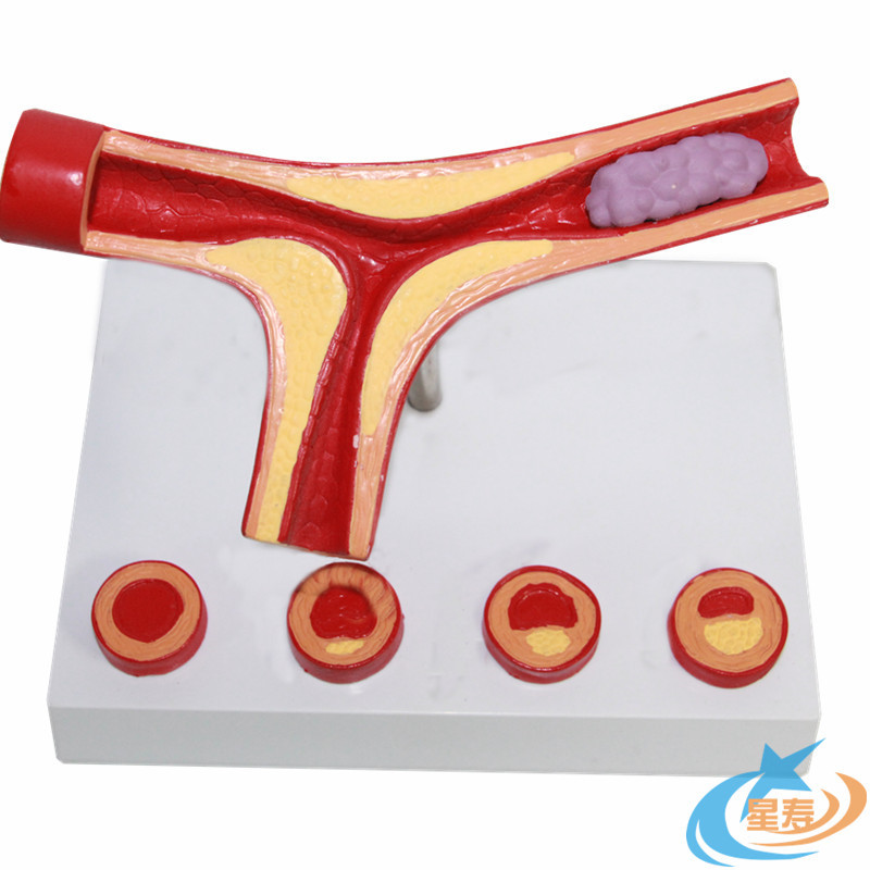 星寿人体血管放大模型血栓模型血管模型