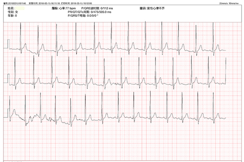 案例 > 心律不齐还能买保险吗 窦性心律不齐能买保险吗  窦性心律失常