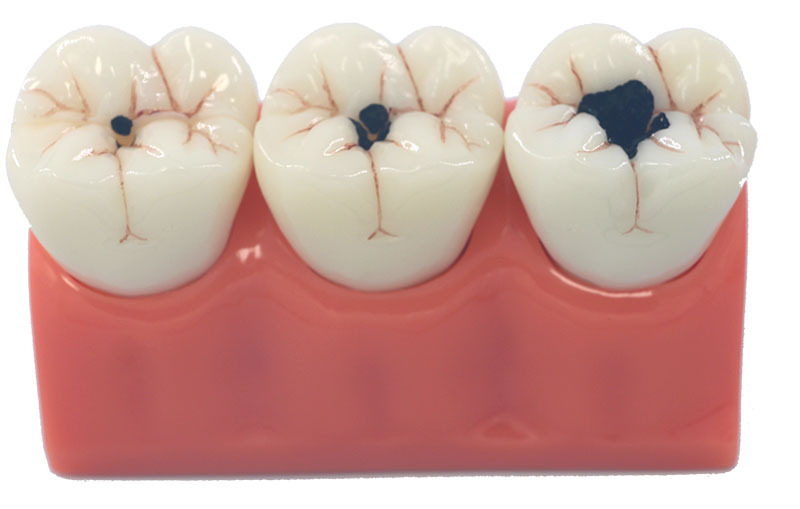 星寿品牌放大3倍龋齿病分解解剖模型牙齿模型口腔牙保健护理模型