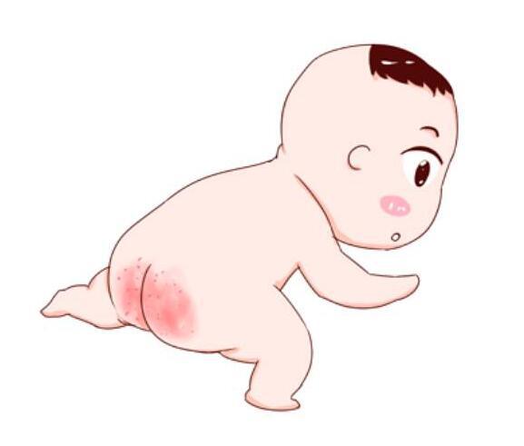 宝宝红屁股都怪纸尿裤!纸尿裤听完都方了