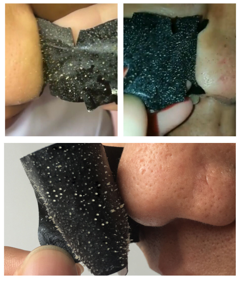 兰廷坊清肌吸黑头强鼻贴去黑头撕拉式黑头猪贴鼻膜女男缩小毛孔