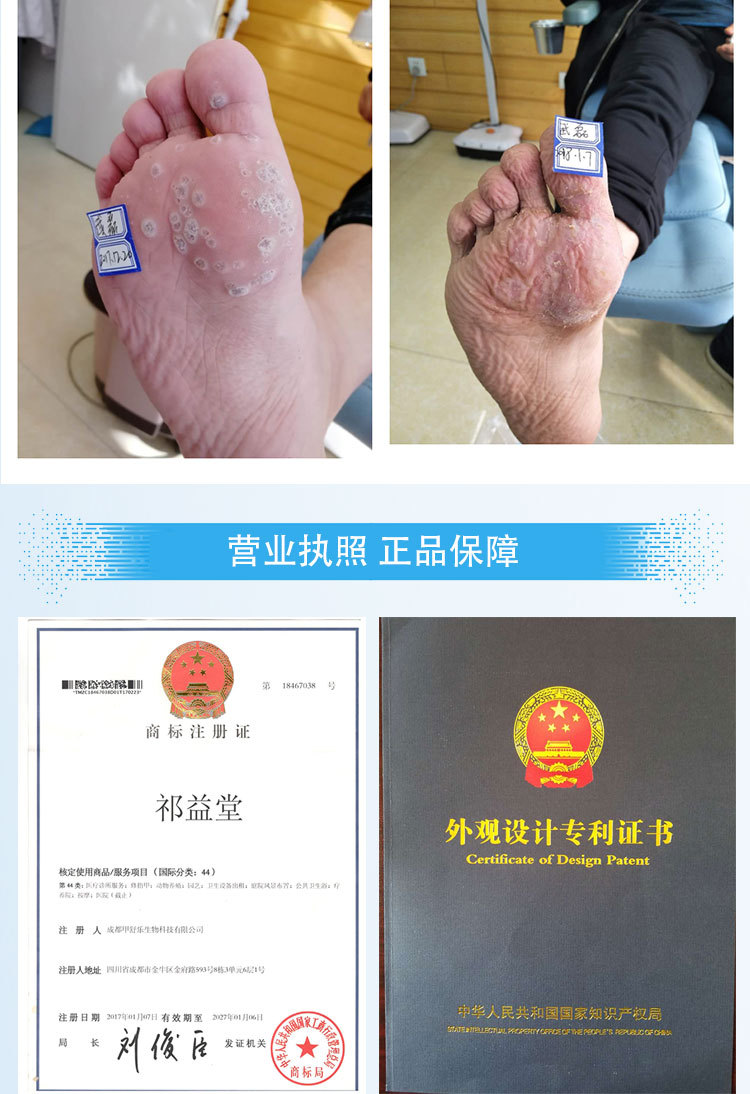 灰指甲脱甲膏 无疼痛 不刺激 贴牌鸡眼脚垫甲丽净 厂家oem