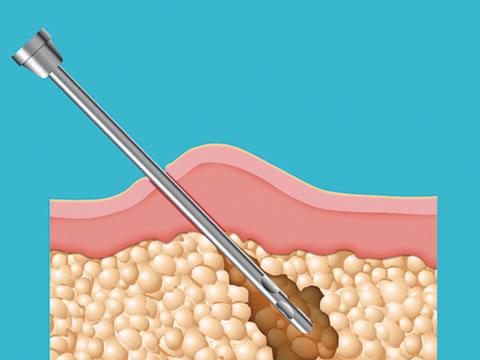 【交流互动】 - 抽出来十斤脂肪的图片,脂肪还会再长吗?