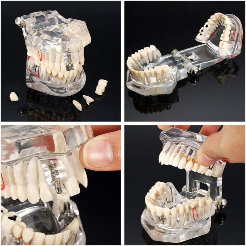 牙科模型 透明可拆卸理种植牙模型 连桥牙髓演示模型