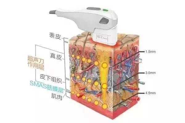 超声刀的副作用有哪些?