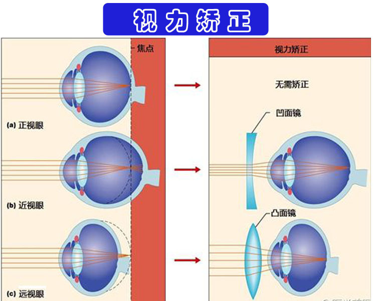 一线棱镜双光中子镜青少年防控三棱镜近视预防