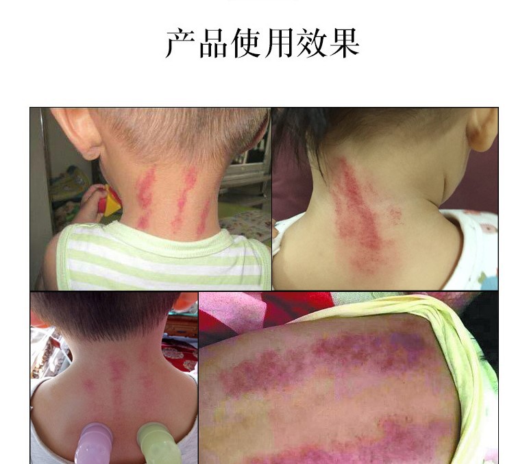 小儿推拿拔罐易罐益罐走罐刮痧出痧快小孩儿童硅胶负压罐软硬可选