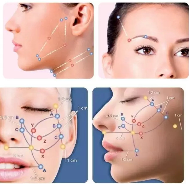 黄金线雕是什么原理?大v线提升面部好吗?看完这些让你秒懂?