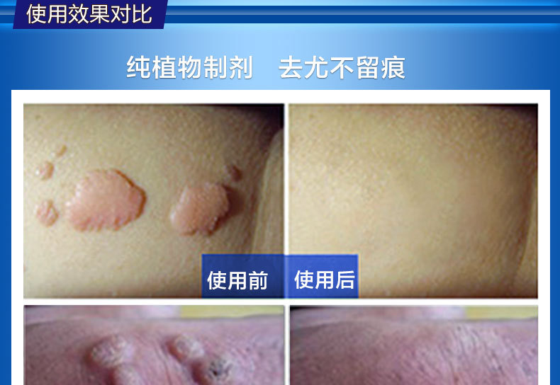 诗莱格克疣净 去疣灵肉刺瘊子尖锐疣湿疣病毒克星丝状尤扁平疣