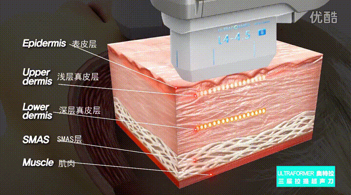 超声刀副作用,防忽悠
