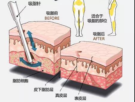 抽脂减肥好恐怖,危险事件不断上升,我们来看看
