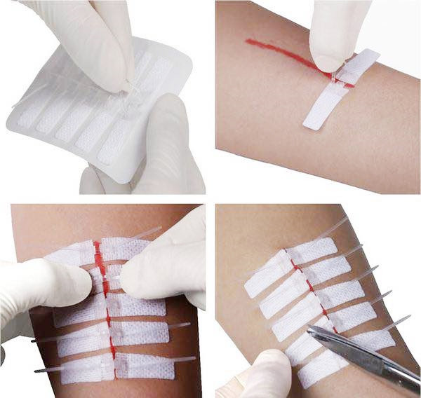 户外免缝胶带伤口快速缝合拉链式创可贴 新型免缝针创口贴