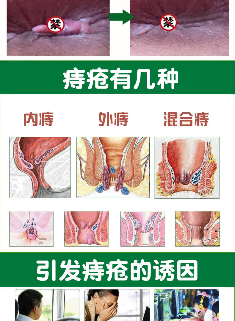 云南本草根必痔痔疮膏消肉球男女混合痔膏外oem批发六福本草