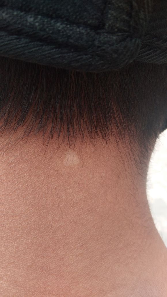 手臂汗斑花斑癣怎么治