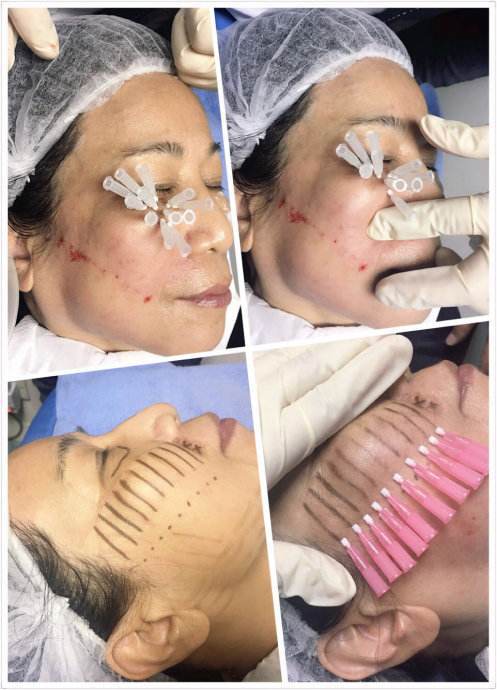 做完线雕让我看起来年轻了十岁