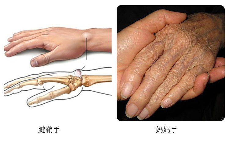 腱手护托鞘大拇指骨手腕康炎折固定带妈妈复手女护腕保套保护暖