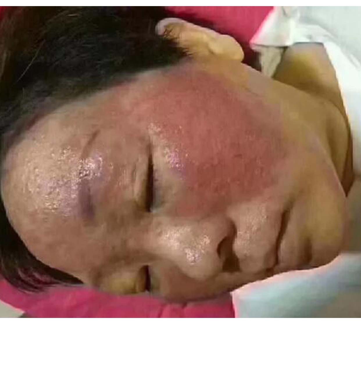 蛋白线面部埋线提升的副作用且听acme-te-a娓娓道来!