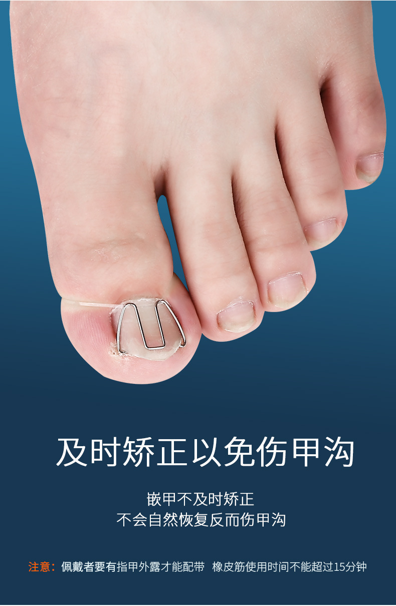 正甲丝甲沟嵌甲矫正器脚趾甲长头里矫正丝卷甲炎修脚工具正甲勾-阿里