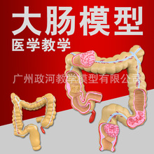 大肠病理模型 肠胃模型 大肠病变模型 肠道疾病 人体结肠病变模型
