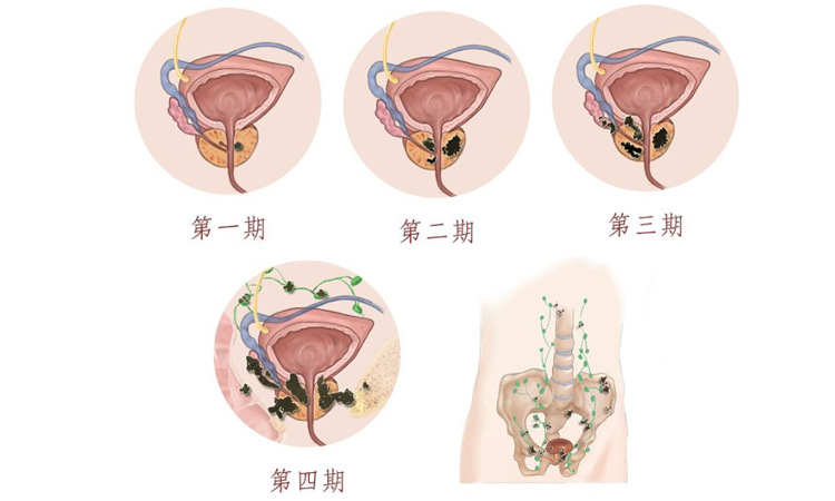 男人注意了:牛奶喝太多小心引发前列腺癌!