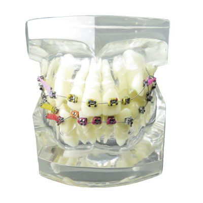 水晶牙套模型齿科戴彩链带金属托槽弓丝颊面管错额正畸模型