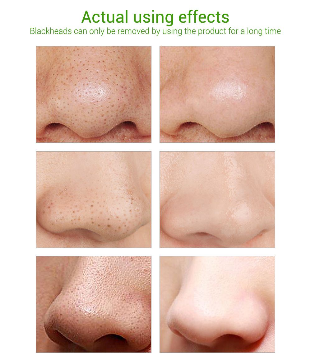 lanbena蓝蓓娜黑头导出液15ml 祛白头粉刺女男士深层清洁鼻