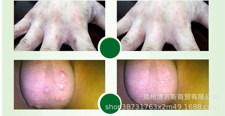 虱疥一扫光 去除结疥 阴虱芥疮 乳膏软膏跑江湖地摊批发一件代发