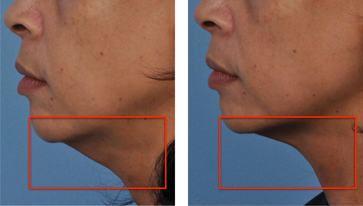 美国超声刀效果对比照片,效果怎么样?