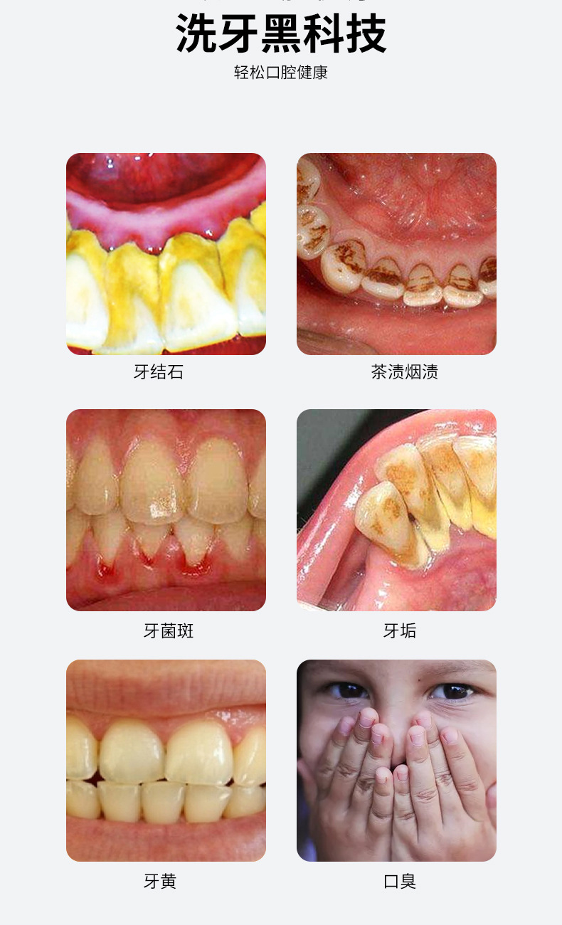 清理牙结石的方法图片