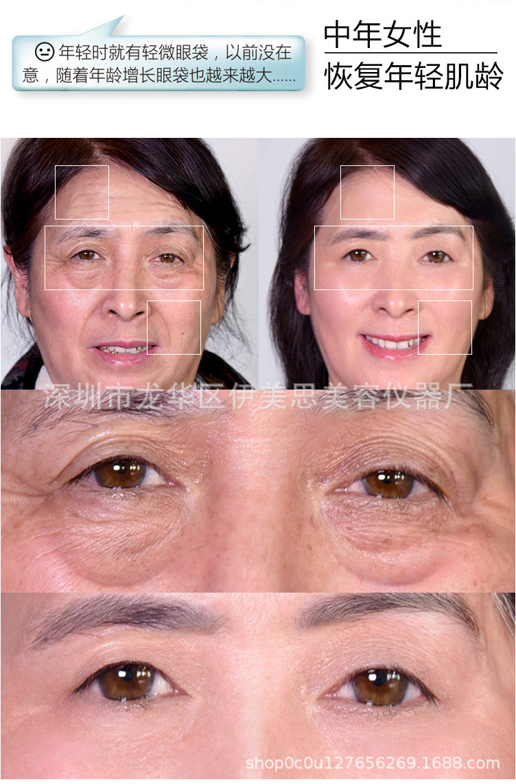 韩国vmax无针雷达精雕提拉紧致祛皱无针逆龄线雕仪美容院专用