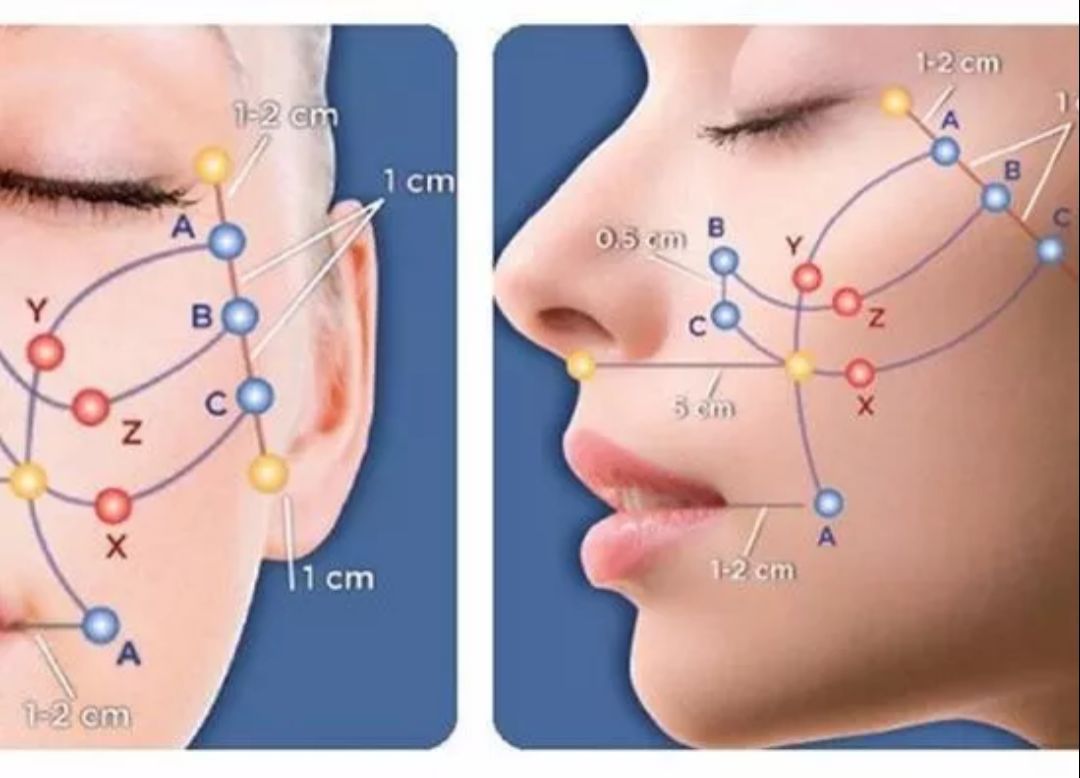 脸埋线提升效果好不好?埋线前后差距大不大?