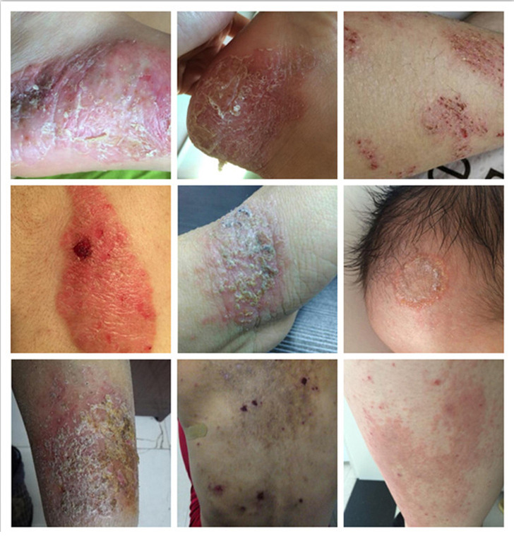 百峰草断癣拔毒膏清毒去痒除藓断痒拔毒膏草本乳膏湿痒膏地摊批发