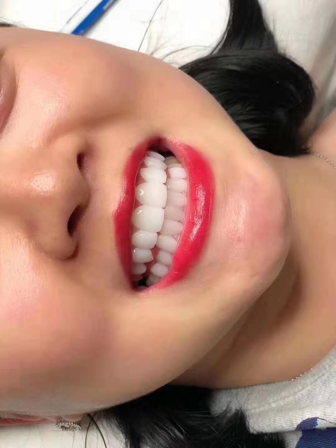 全瓷贴片贴面制作美牙白 明星全瓷贴面矫正牙齿贴片贴面 私人订