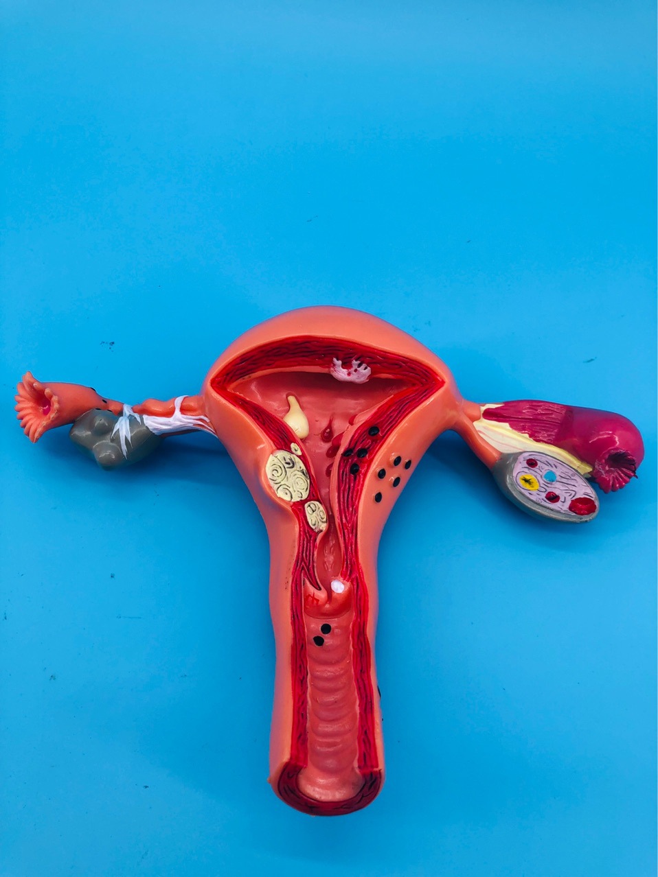 人体子宫病变模型