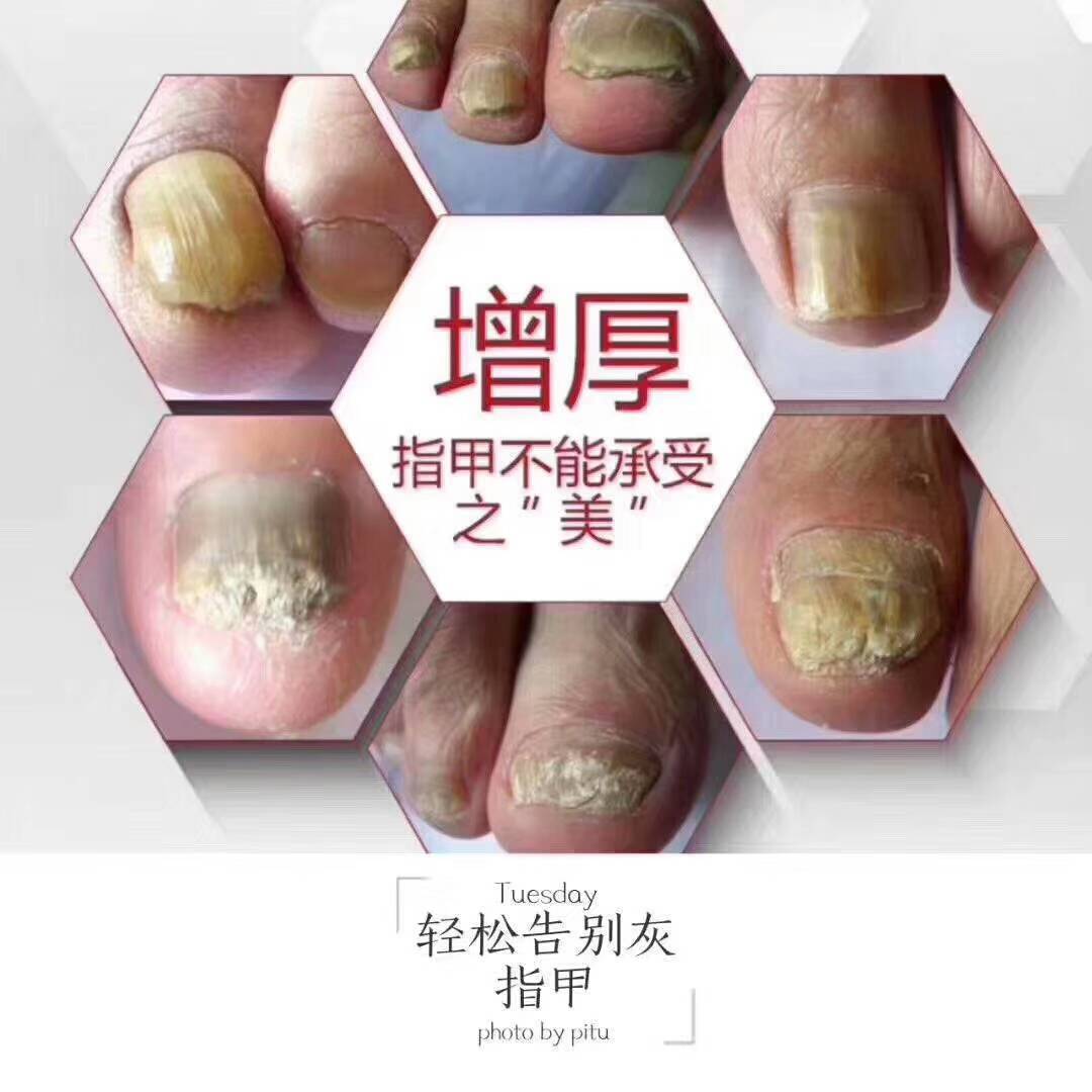 刮去污物; 涂甲疗法:可选用复方土槿皮酊,甲癣方或鲜风仙花捣烂如泥状