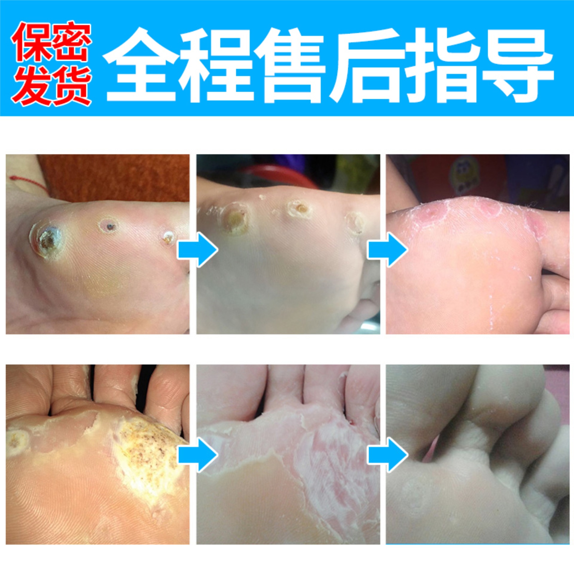 瘊疣鸡眼膏鸡眼贴尖锐痣肉刺湿忧扁平刺猴瘊子净跖疣oem地摊货源