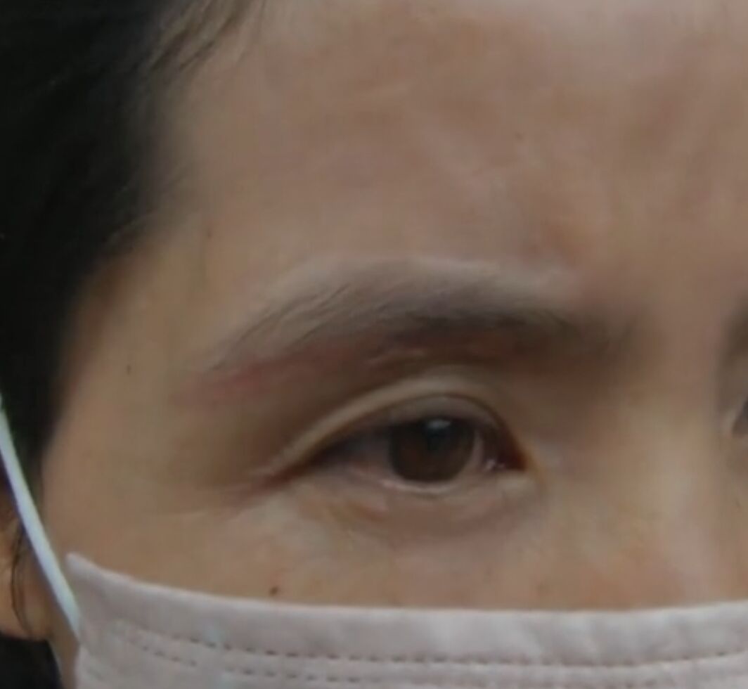 切眉手术后老得快是副作用的原因吗?答案你绝对想不到!