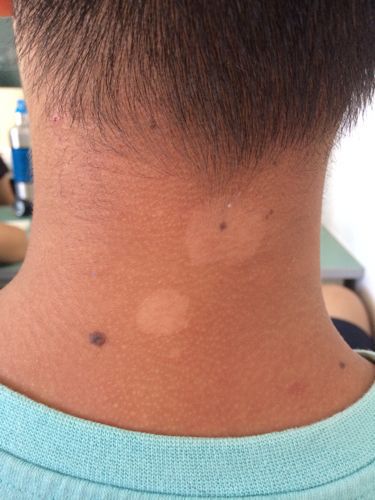 小孩脸上汗斑花斑癣怎么去除?面部汗斑愁人?