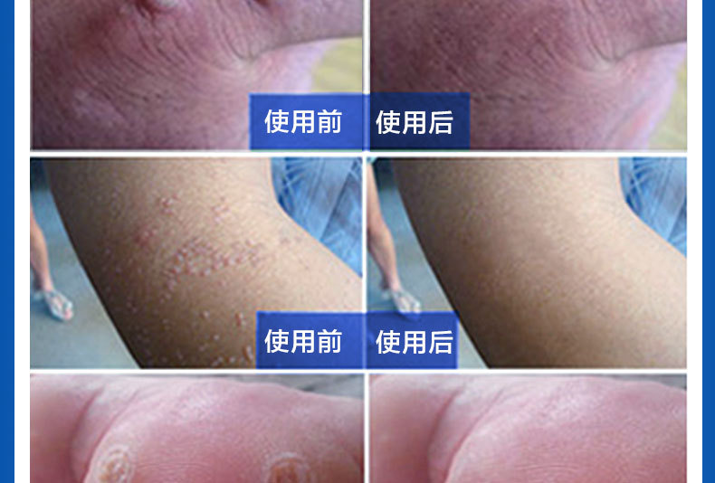 诗莱格克疣净 去疣灵肉刺瘊子尖锐疣湿疣病毒克星丝状尤扁平疣