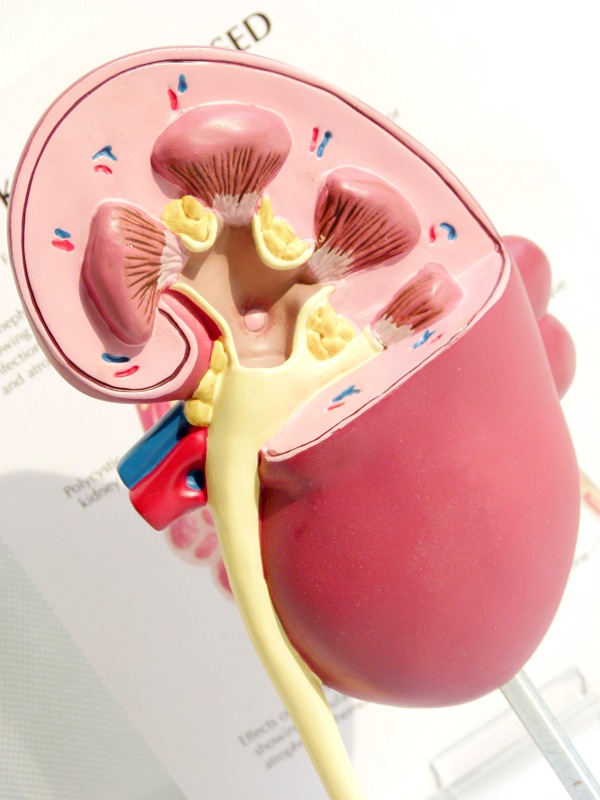 人体肾解剖模型,病变肾脏模型 肾脏模型 人体内脏器官解剖模型
