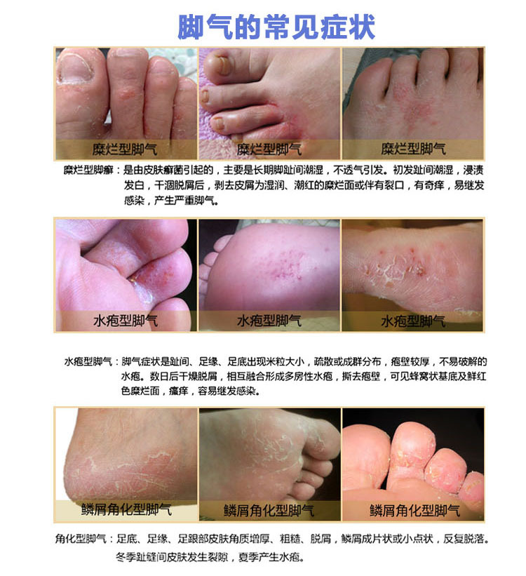 泡脚液去真菌止痒脱皮脚气脚臭脚痒烂脚丫除臭水泡神器oem
