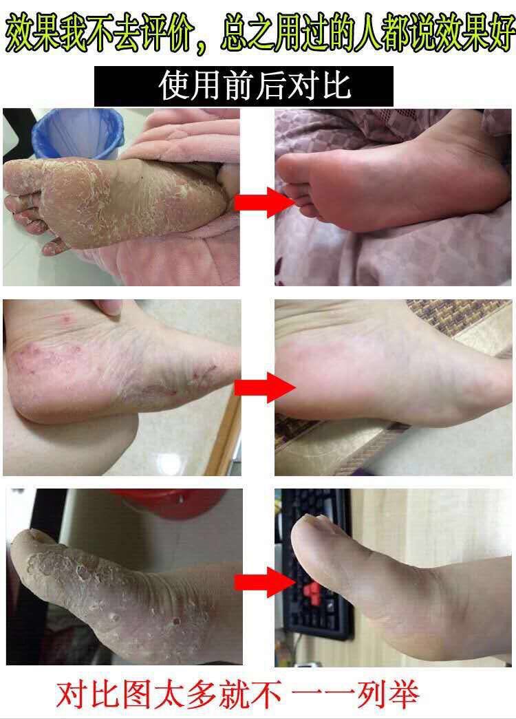 欧果足记脚气药脚气喷剂去脚气脚臭脚痒脚汗止痒脱皮糜烂药水脚癣