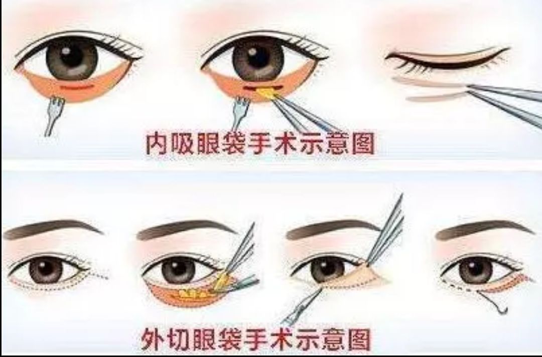眶隔释放术