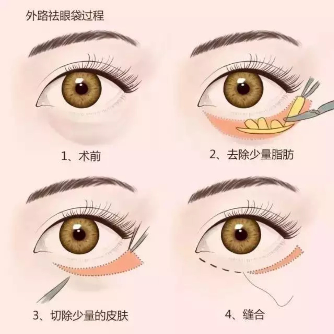 2.内切法去眼袋