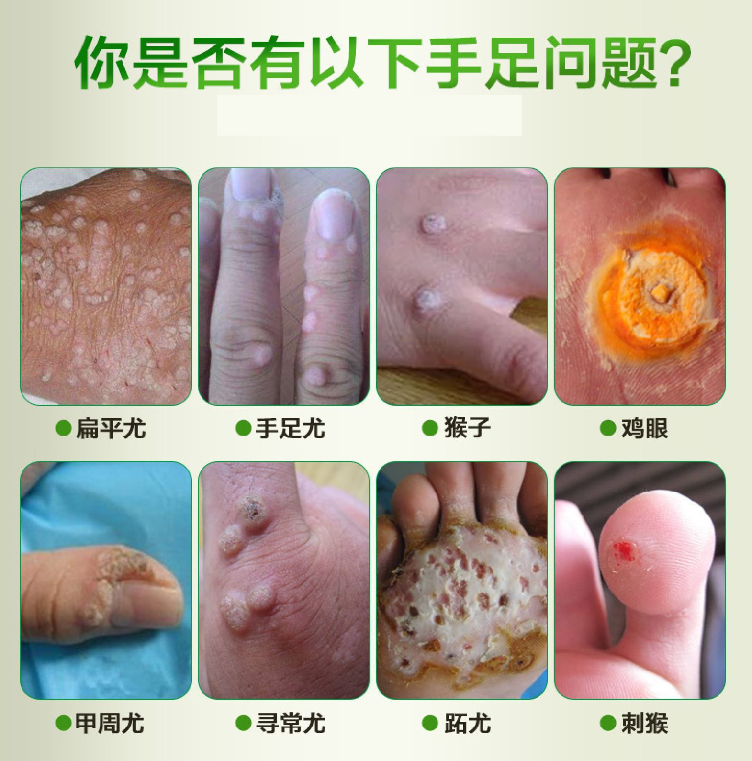 oem贴牌医疗器械批文鸡眼膏鸡眼液老茧脚裂除脚趾贴祛瘊子跖疣液