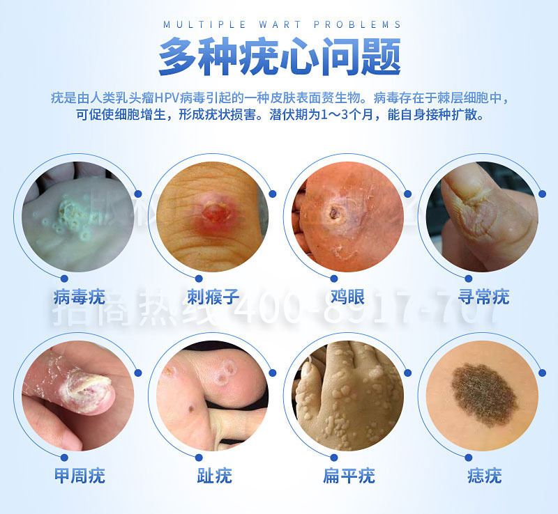 瘊疣平疣净鸡跖疣眼脚刺垫老茧肉刺扁平疣去疣液祛疣膏
