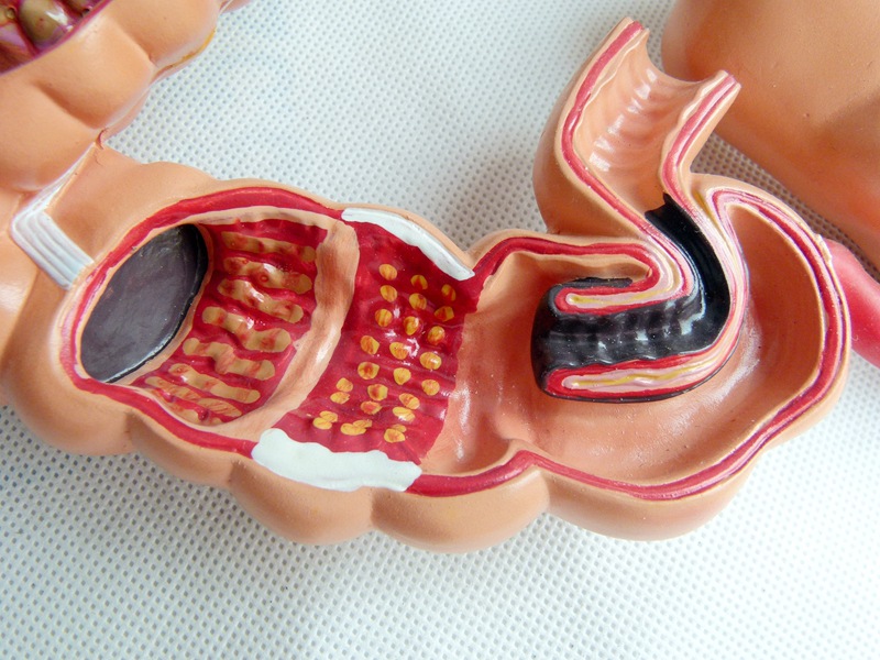 人体结肠病变模型肛肠科消化内科大肠模型医学人体解剖学