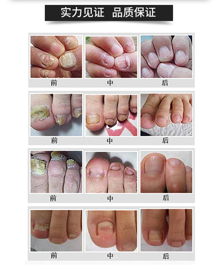七草立清灰指甲抑菌液 专用灰指甲液一笔亮批发代发5ml